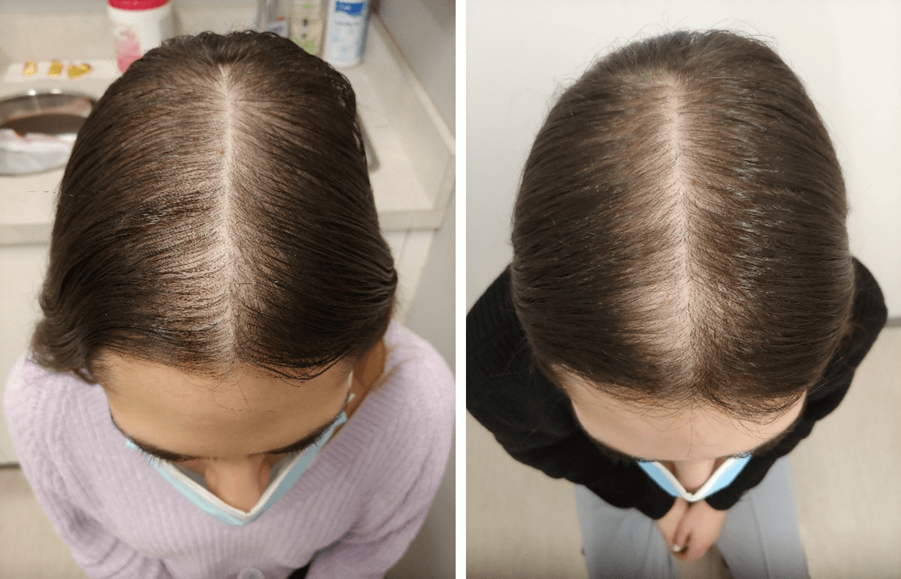 TED Before & After